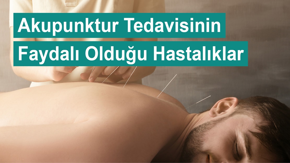 Akupunktur Tedavisinin Faydalı Olduğu Hastalıklar